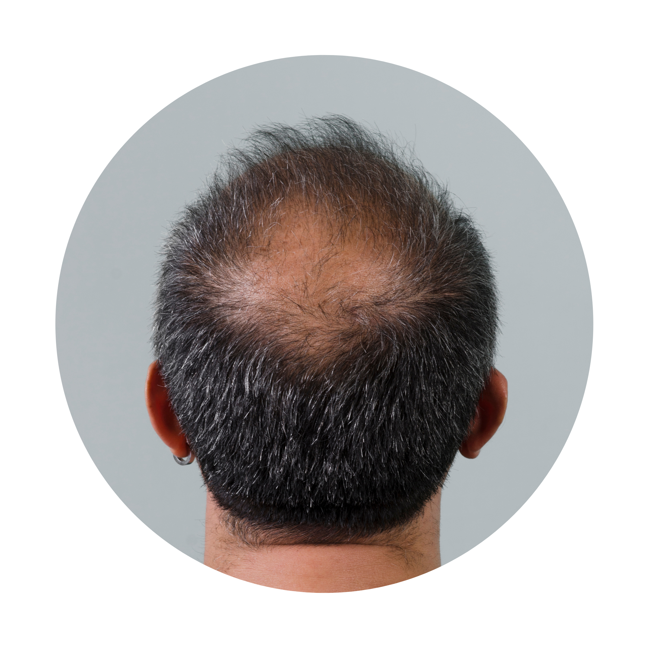 Dermavers Clinic Treatment HAIR SOLUTION