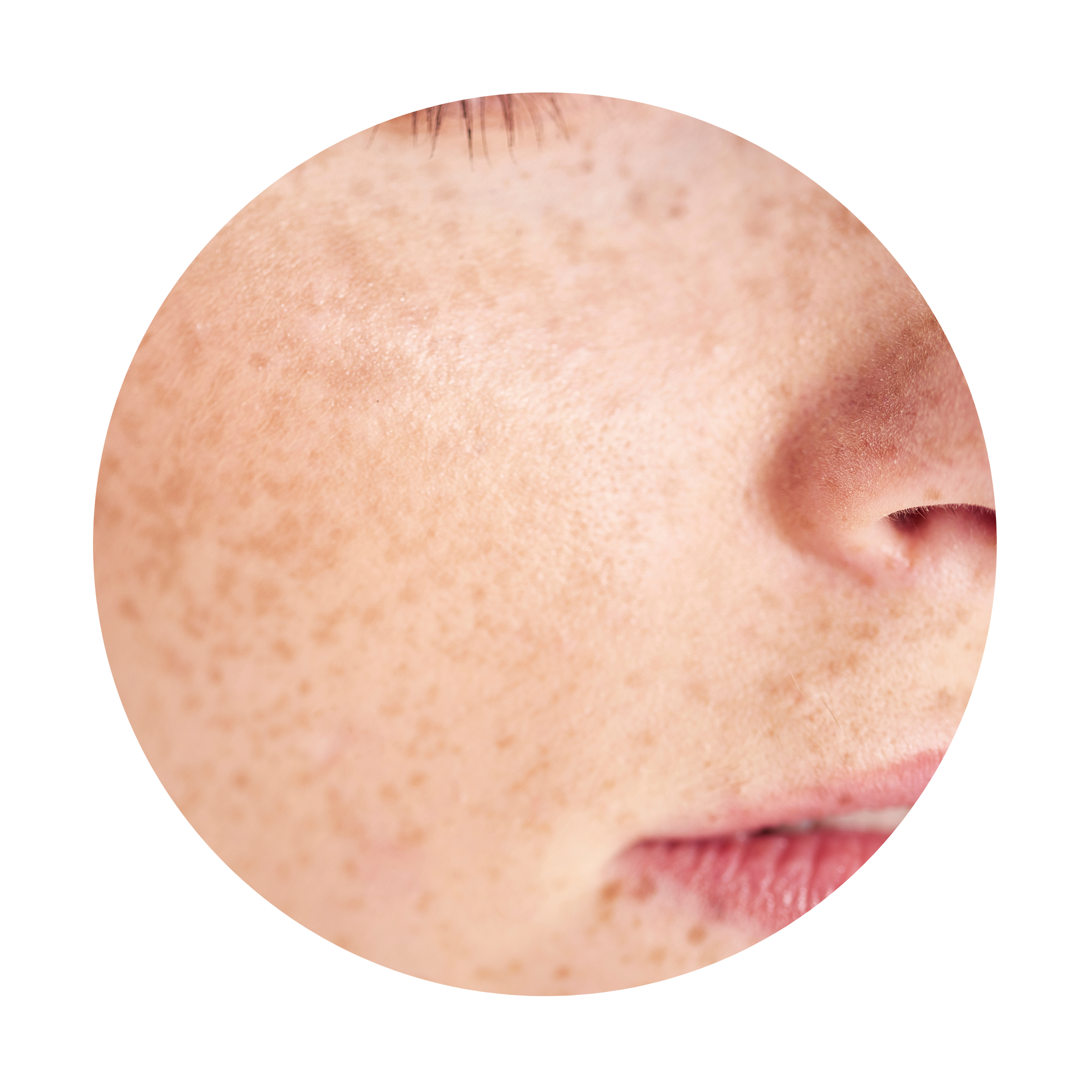 Dermavers Clinic Treatment PIGMENTATION