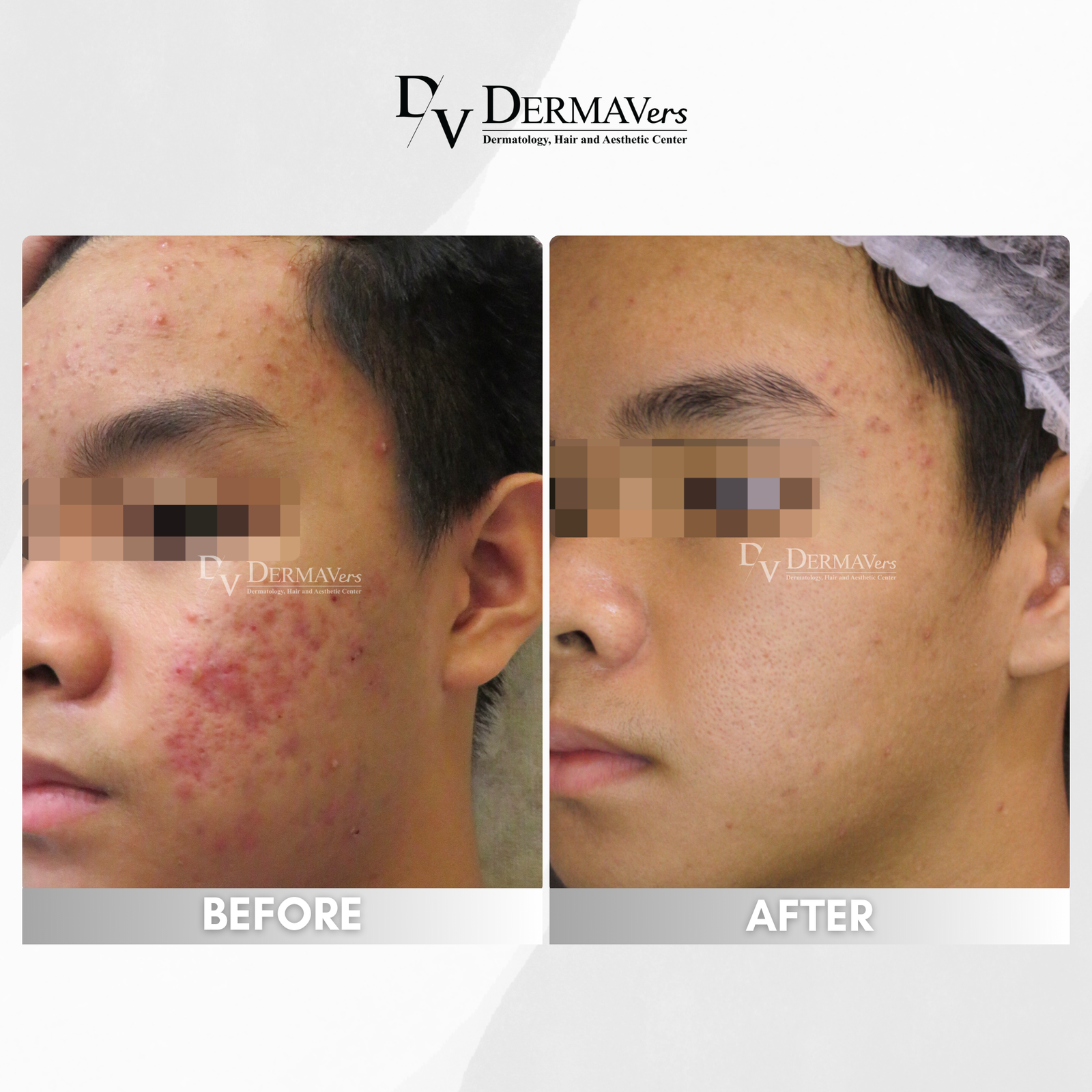 Before and After Problem Area Photo
