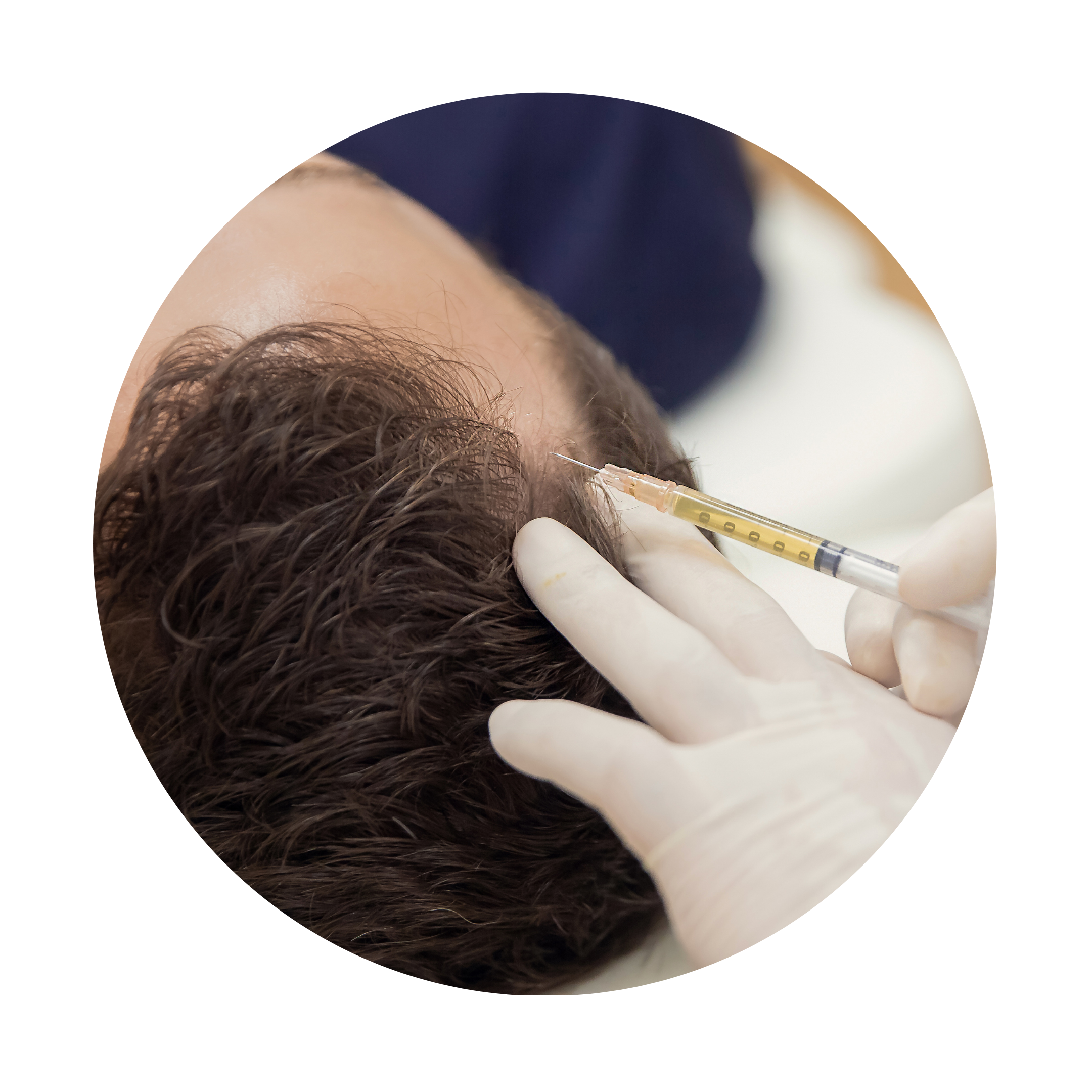 PLATELET RICH PLASMA (PRP)